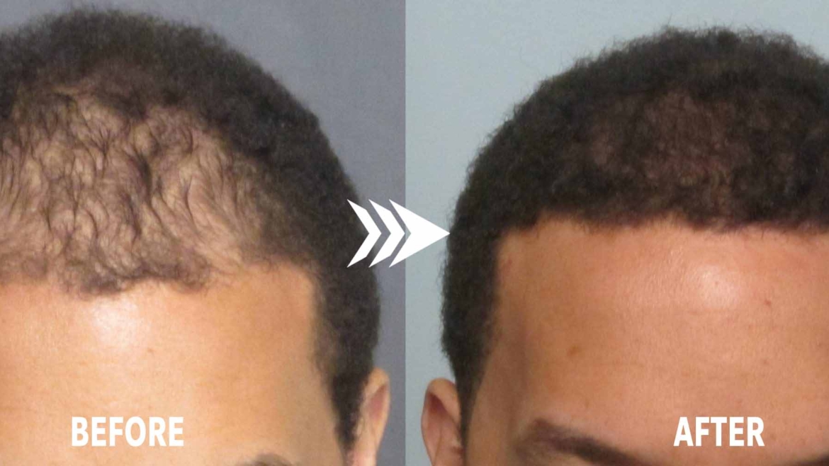 FUE Hair Transplant