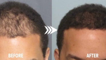 FUE Hair Transplant