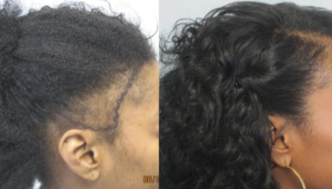Female Hair Transplant