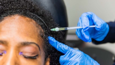 PRP Hair Treatment