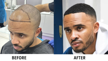 Afro Hair Transplant