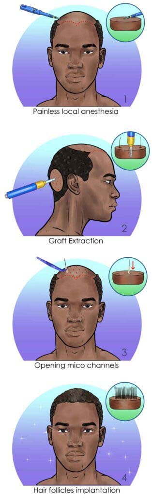 Afro Hair Transplant