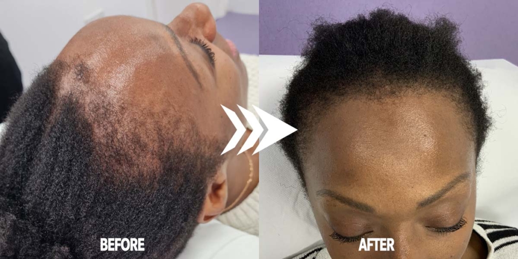 Afro Hair Transplant