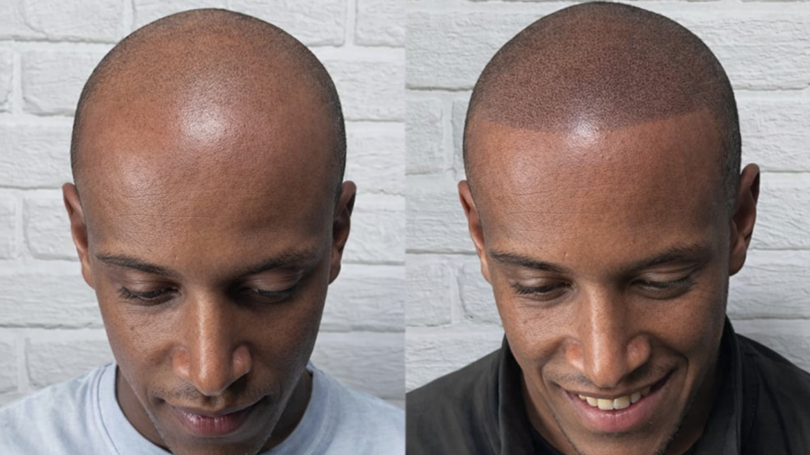 Scalp Micropigmentation