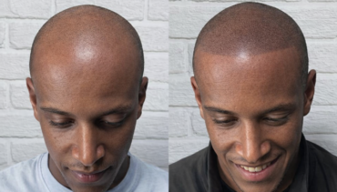 Scalp Micropigmentation